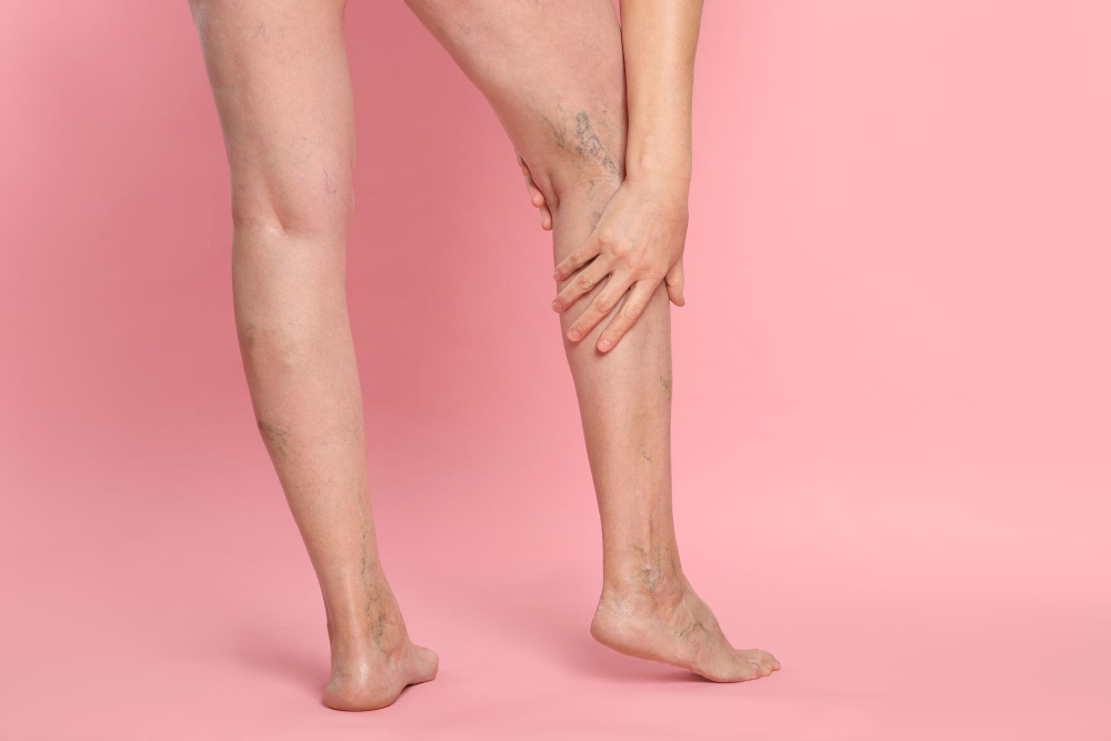 Varices à Meknès : Pourquoi de plus en plus de patients choisissent un centre spécialisé à Casablanca ?