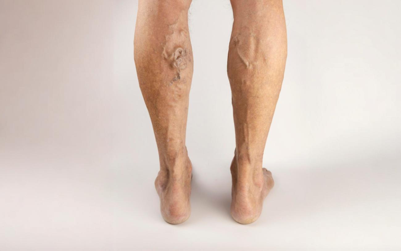 Traitement esthétique des varices à Tanger : pourquoi choisir un centre expert du “LASER amélioré” à Casablanca ?